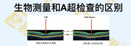 生物測(cè)量和A超檢查的區(qū)別