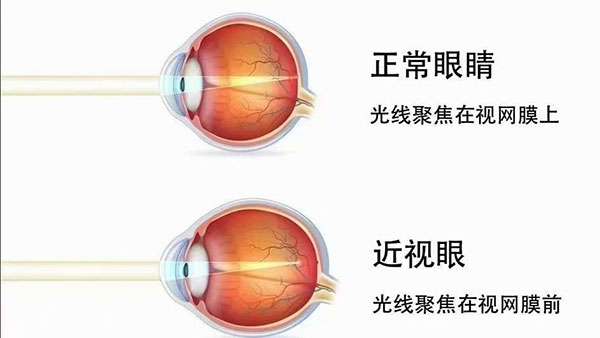 眼睛正視化的過(guò)程