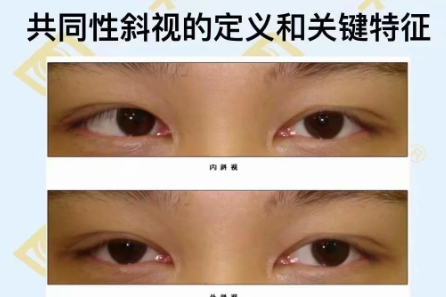 共同性斜視的定義和關鍵特征