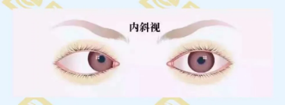 什么是調(diào)節(jié)性內(nèi)斜視？