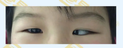 什么是先天性內(nèi)斜視？