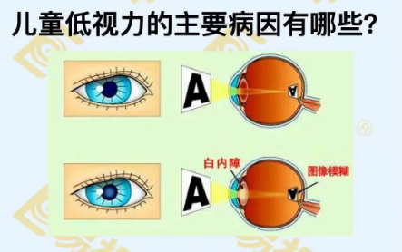 兒童低視力主要病因有哪些？
