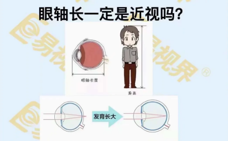 眼軸長(zhǎng)一定是近視嗎？