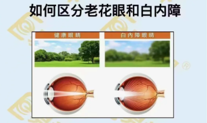 如何區(qū)分老花眼和白內(nèi)障?