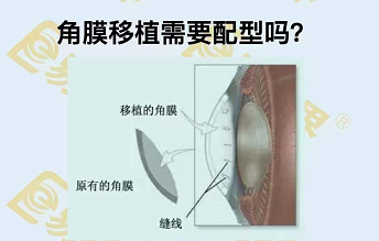 角膜移植需要配型嗎？