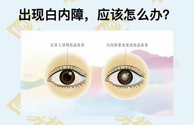 出現(xiàn)白內(nèi)障應該怎么辦